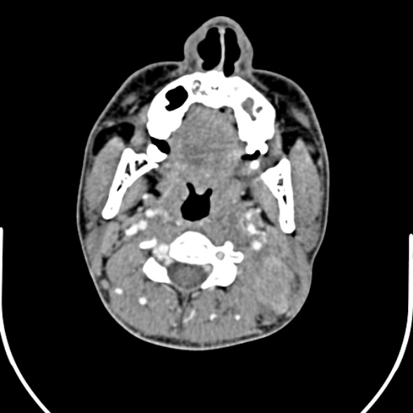 Nasopharyngeal carcinoma with skull base invasion (Radiopaedia 53415-59705 A 88).jpg