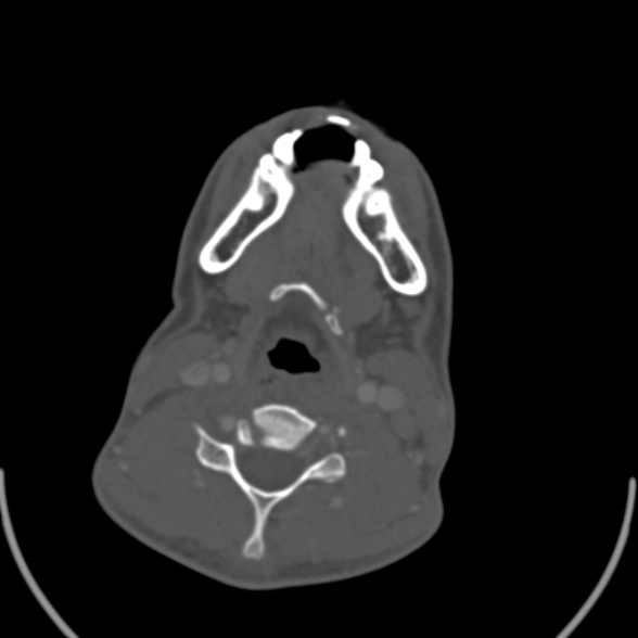 Nasopharyngeal carcinoma with skull base invasion (Radiopaedia 53415-59705 Axial bone window 132).jpg