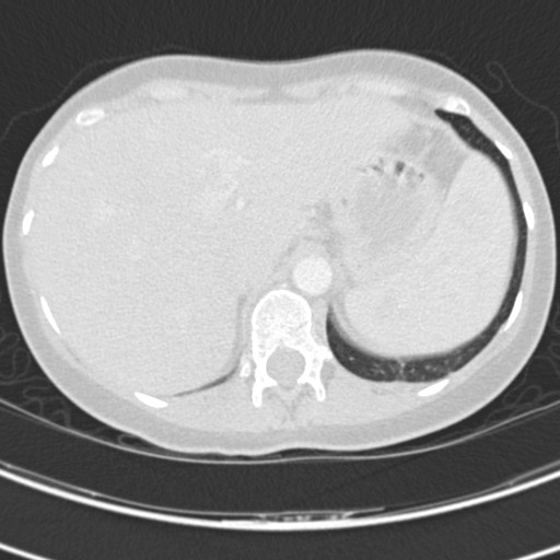 Necrobiotic pulmonary nodules - Crohn disease (Radiopaedia 20723-20631 Axial lung window 133).jpg