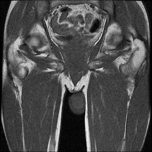 File:Necrotizing epididymo-orchitis with intra-testicular abscess (Radiopaedia 29397-29860 Coronal T1 17).jpg