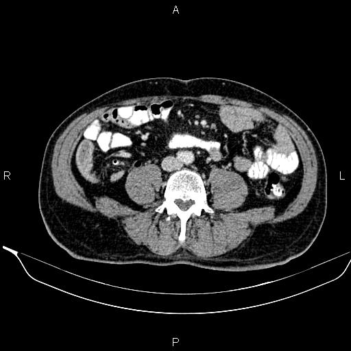 Necrotizing pancreatitis (Radiopaedia 87796-104249 A 35).jpg