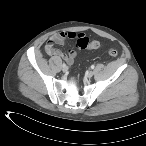File:Necrotizing pancreatitis with acute necrotic collections (Radiopaedia 38829-41012 B 65).png