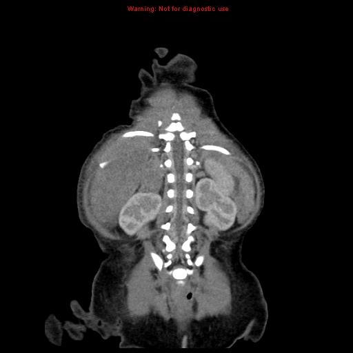 File:Neonatal neuroblastoma (Radiopaedia 9564-10223 B 100).jpg