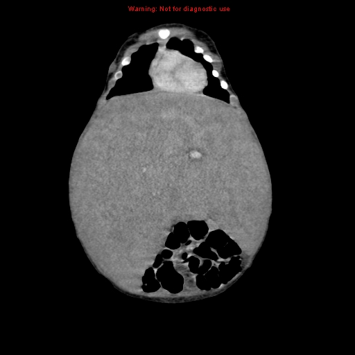 File:Neonatal neuroblastoma (Radiopaedia 9564-10223 B 39).jpg