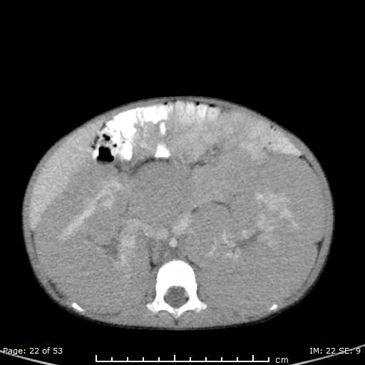 Nephroblastomatosis (Radiopaedia 41934-44935 A 22).jpg