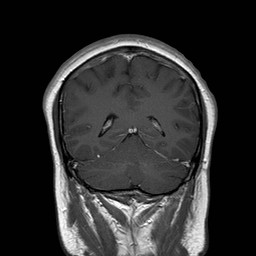 File:Neuro-Behcet's disease (Radiopaedia 21557-21505 Coronal T1 C+ 16).jpg