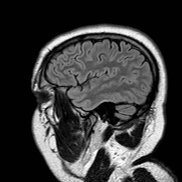 File:Neuro-Behcet's disease (Radiopaedia 21557-21506 Sagittal FLAIR 5).jpg