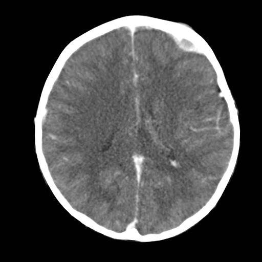 File:Neuroblastoma (Radiopaedia 8176-36438 B 2).jpg