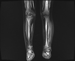 File:Neuroblastoma with bone metastases (Radiopaedia 67080-76414 B 7).jpg