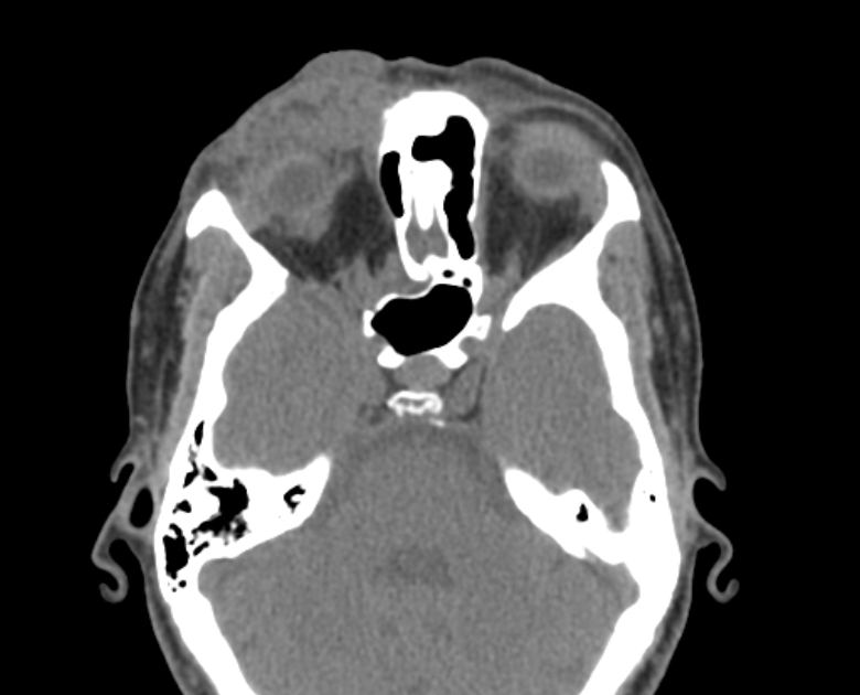 Neurofibromatosis type 1- orbital manifestations (Radiopaedia 49391-54511 Axial non-contrast 53).jpg