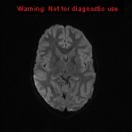 File:Neurofibromatosis type 1 with optic nerve glioma (Radiopaedia 16288-15965 Axial DWI 36).jpg