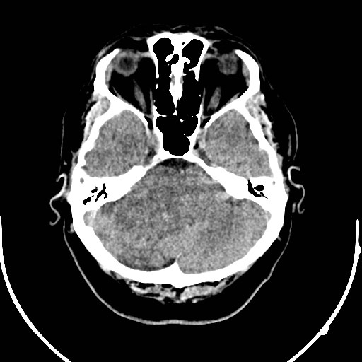 Neurofibromatosis type 2 (Radiopaedia 79097-92047 Axial non-contrast 14).jpg