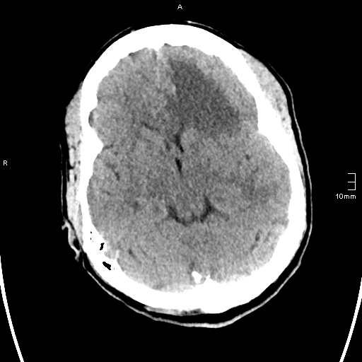 File:Neurotoxoplasmosis - concentric target sign (Radiopaedia 70644-80783 Axial non-contrast 14).jpg