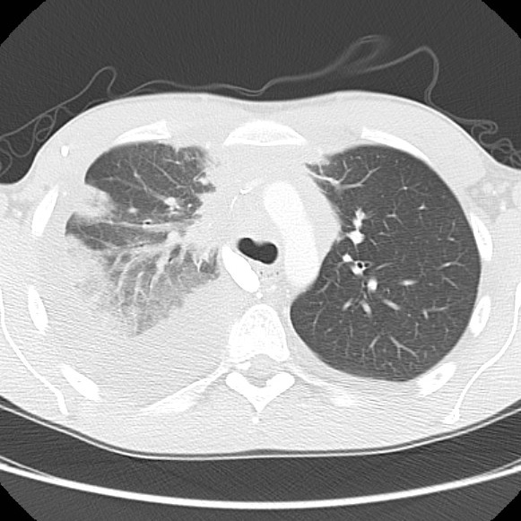 File:Non-Hodgkin lymphoma involving lung (Radiopaedia 29094-29470 Axial lung window 25).jpg