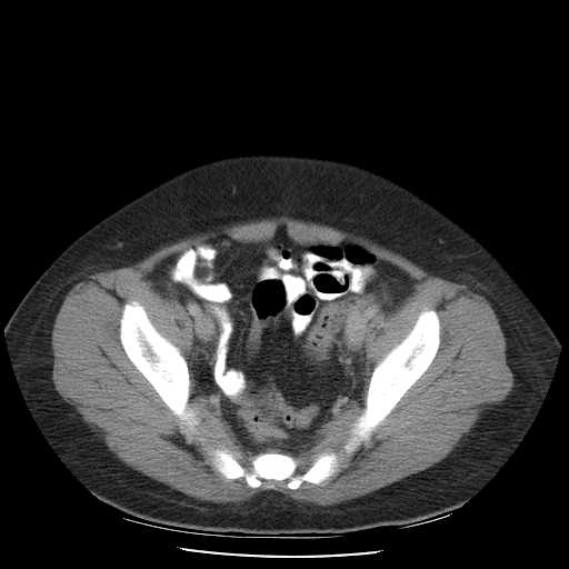 File:Non-Hodgkin lymphoma involving pelvis (Radiopaedia 21281-21197 A 52).jpg