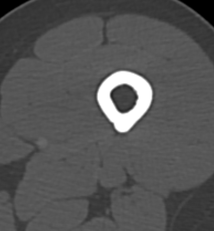 Non-ossifying fibroma - femur (Radiopaedia 82786-97042 Axial bone window 7).jpg