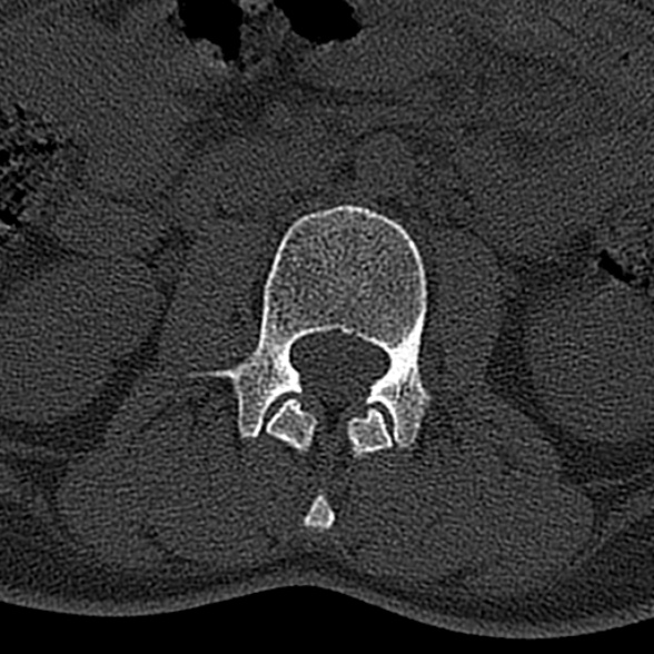 File:Normal CT lumbar spine (Radiopaedia 53981-60118 Axial bone window 32).jpg