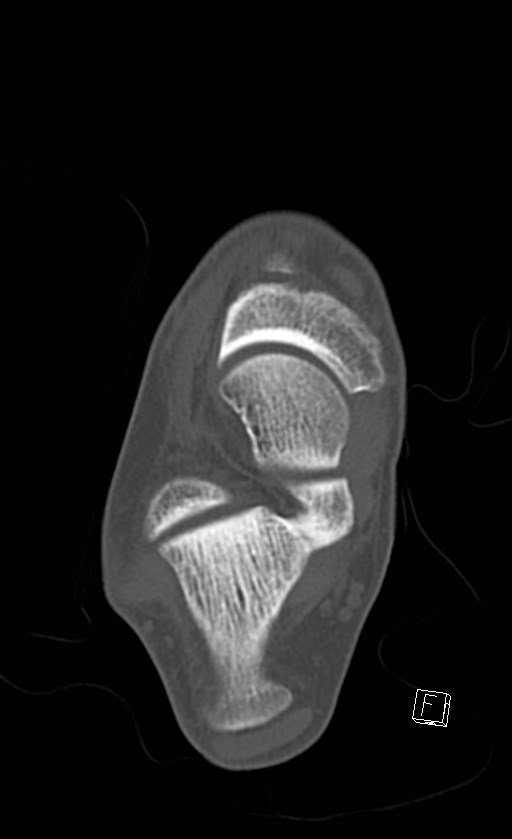 Normal CT of the ankle (Radiopaedia 47111-51658 Axial bone window 58).jpg
