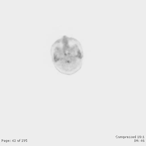 File:Normal F-18 FDG PET-CT (Radiopaedia 77382-89510 C 42).jpg