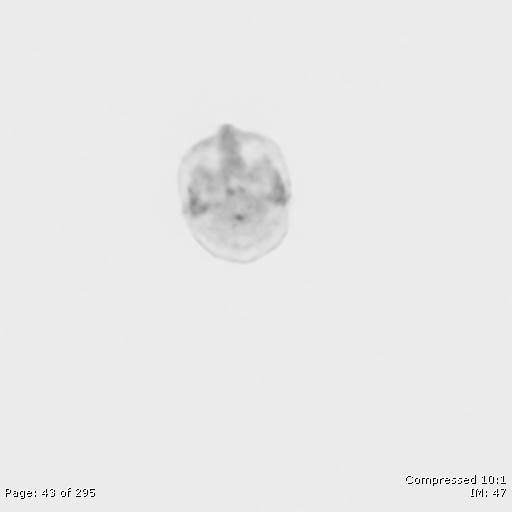 File:Normal F-18 FDG PET-CT (Radiopaedia 77382-89510 C 43).jpg