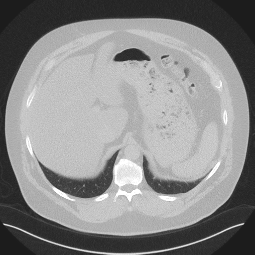 Normal HRCT (Radiopaedia 40797-43458 Axial lung window 54).png
