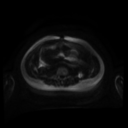 Normal MRI abdomen in pregnancy (Radiopaedia 88001-104541 Axial DWI 107).jpg