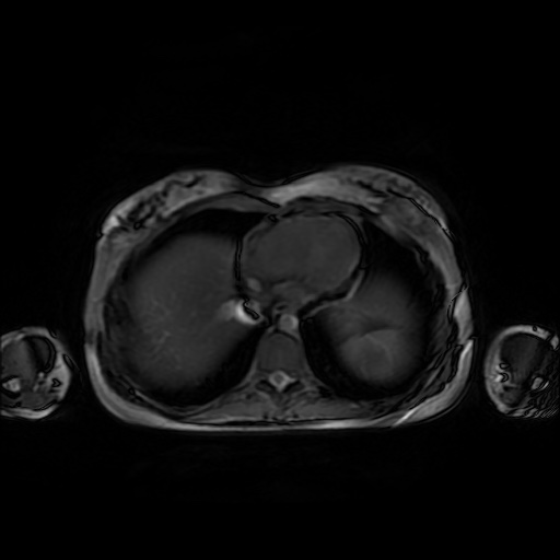 File:Normal MRI abdomen in pregnancy (Radiopaedia 88001-104541 Axial Gradient Echo 4).jpg