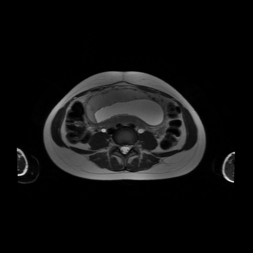File:Normal MRI abdomen in pregnancy (Radiopaedia 88001-104541 Axial T2 40).jpg