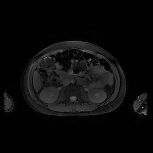File:Normal MRI abdomen in pregnancy (Radiopaedia 88001-104541 D 25).jpg