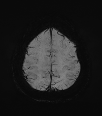 Normal MRI internal auditory canal (Radiopaedia 41613-44525 Axial SWI MIP 66).png