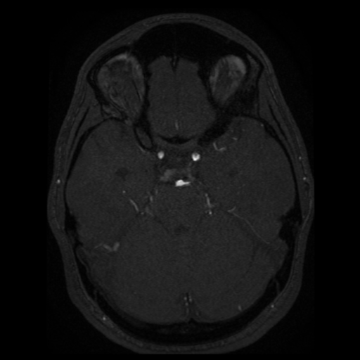 Normal brain MRA (Radiopaedia 41046-43793 Axial MRA 63).png