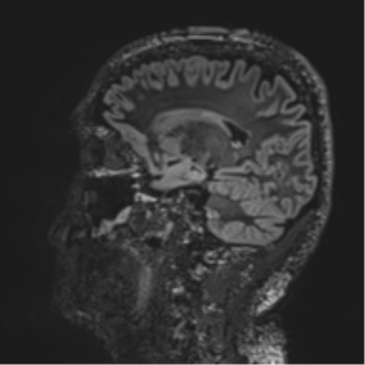 Normal brain MRI (non-focal epilepsy protocol) (Radiopaedia 53917-60040 Sagittal DIR 40).png