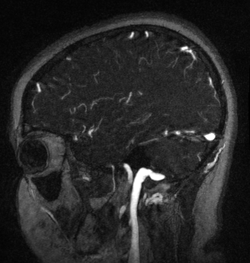 Normal brain MRI and venogram (Radiopaedia 39554-41862 Sagittal MRV 49).jpg