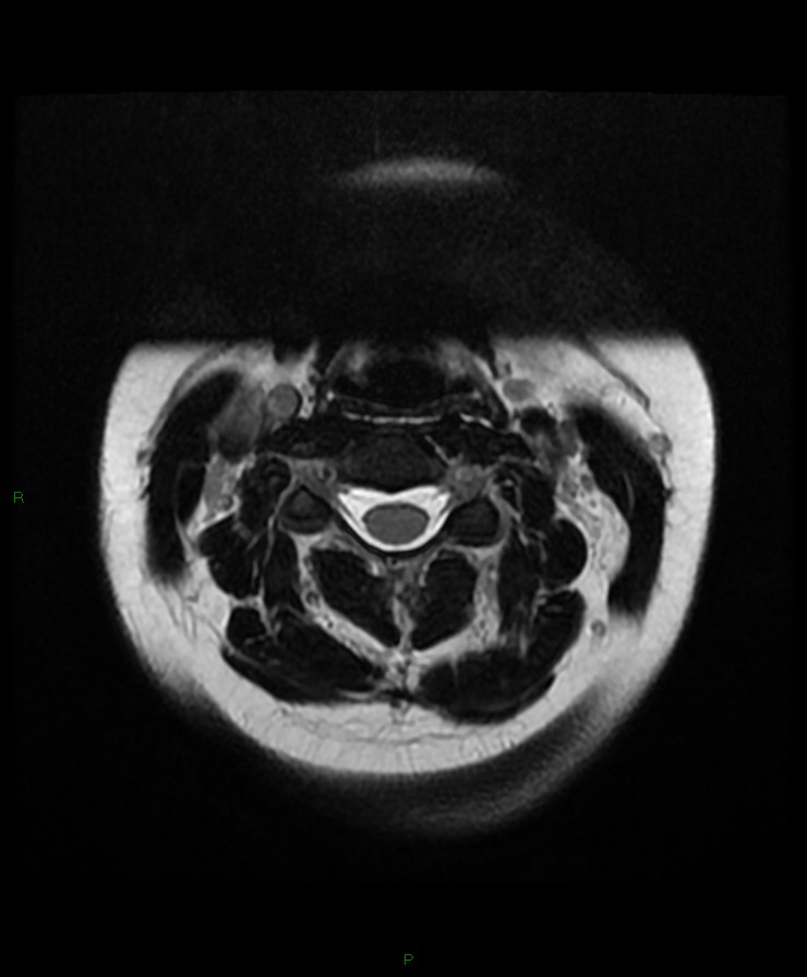 Normal cervical spine MRI (Radiopaedia 80146-93454 Axial T2 29).jpg