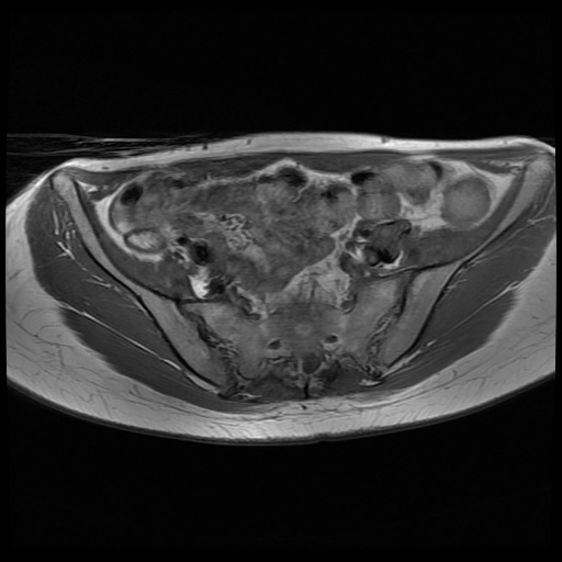 File:Normal female pelvis MRI (retroverted uterus) (Radiopaedia 61832-69933 Axial T1 10).jpg