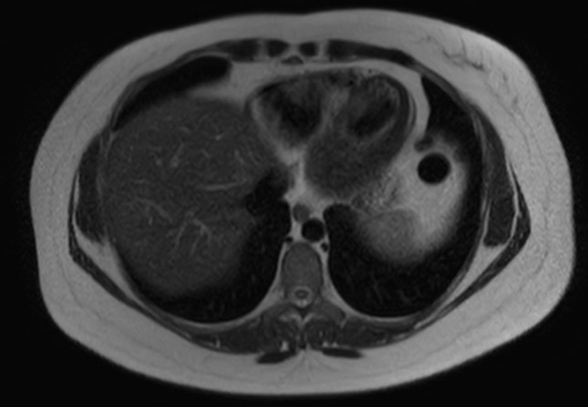File:Normal liver MRI with Gadolinium (Radiopaedia 58913-66163 Axial T2 29).jpg