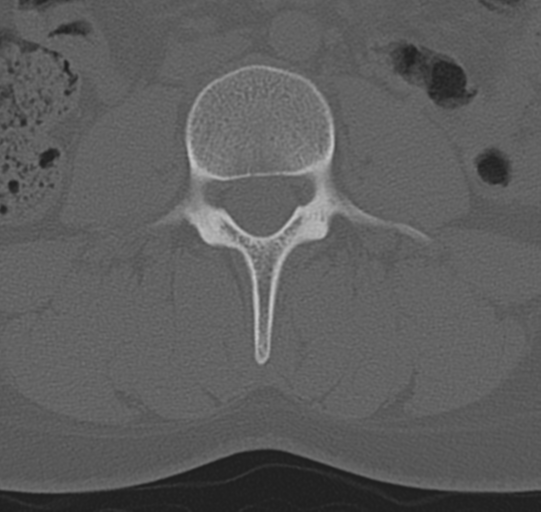 File:Normal lumbar spine CT (Radiopaedia 46533-50986 Axial bone window 37).png