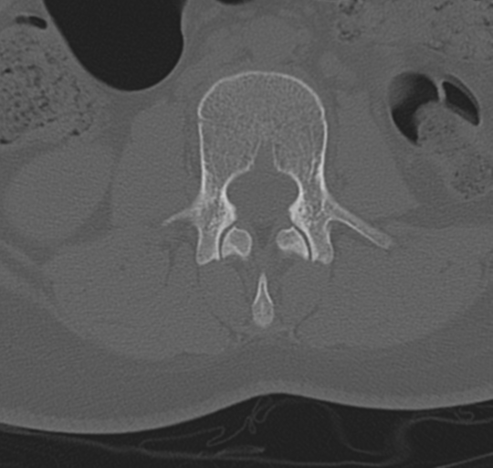 File:Normal lumbosacral CT (Radiopaedia 37923-39867 Axial bone window 50).png