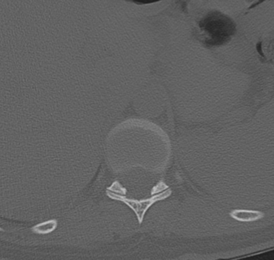 File:Normal lumbosacral CT (Radiopaedia 37923-39867 Axial bone window 7).png