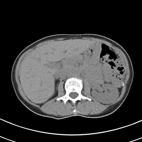 File:Normal multiphase CT liver (Radiopaedia 38026-39996 Axial non-contrast 26).jpg