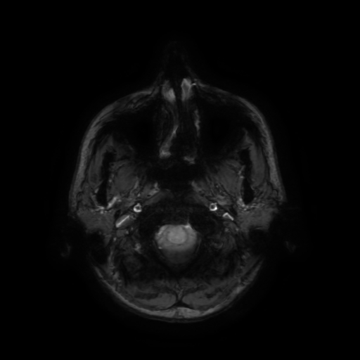 Normal noncontrast MR venography (Radiopaedia 87578-103957 Axial SWI 73).jpg