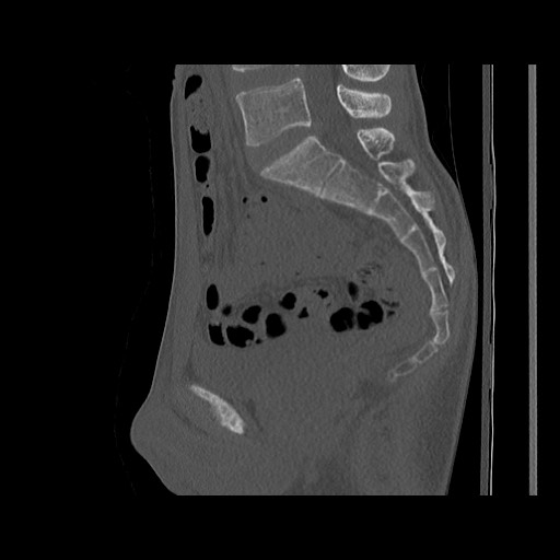 Normal pelvis (Radiopaedia 51473-57238 Sagittal bone window 77).jpg