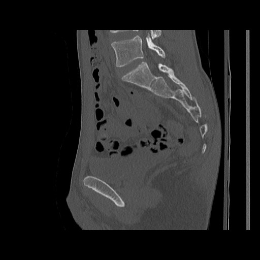 Normal pelvis (Radiopaedia 51473-57238 Sagittal bone window 82).jpg