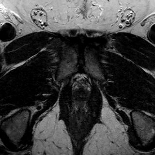 File:Normal prostate (MRI) (Radiopaedia 29986-30535 Axial T2 1).jpg