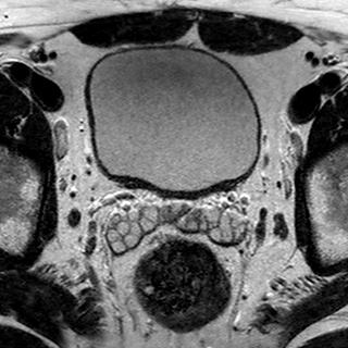 File:Normal prostate (MRI) (Radiopaedia 29986-30535 Axial T2 22).jpg