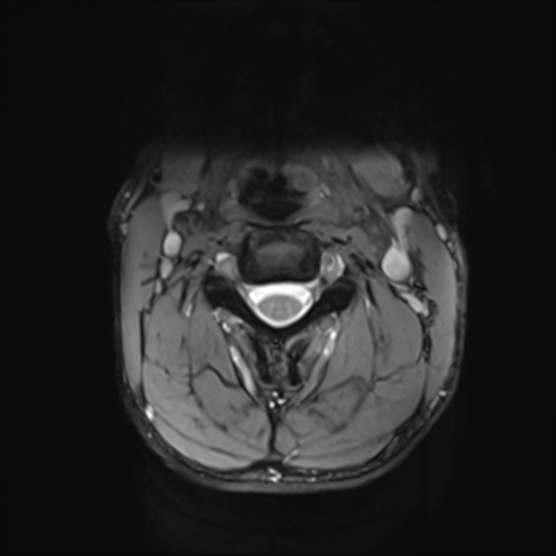 File:Normal trauma cervical spine (Radiopaedia 41017-43762 Axial T2 8).png