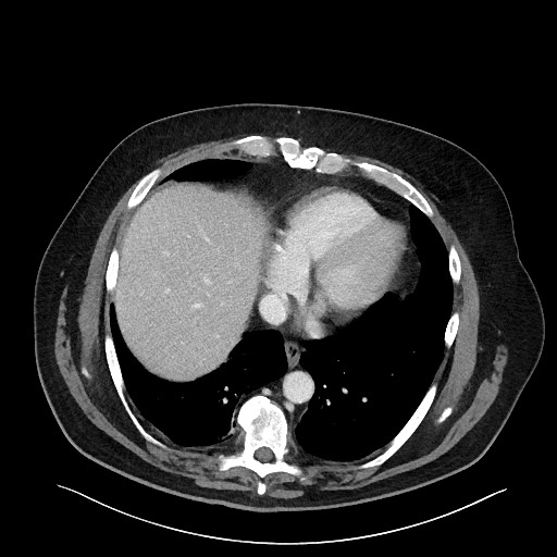 Obstructing sigmoid adenocarcinoma (Radiopaedia 58465-65619 A 19).jpg