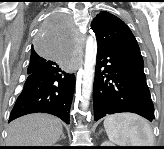 File:Obstructive superior vena cava tumor thrombus (Radiopaedia 28046-28306 B 33).jpg