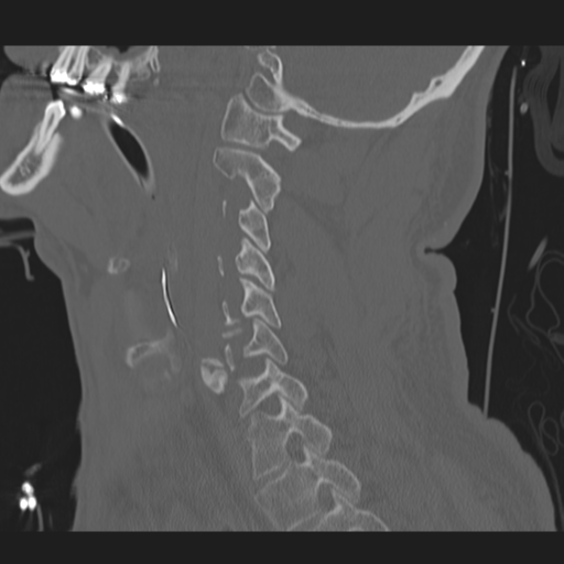 File:Occipital condyle fracture (Radiopaedia 33467-34517 Sagittal bone window 47).png