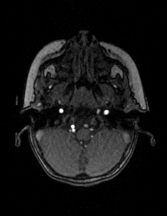 Occipital horn syndrome (Radiopaedia 14255-14129 MRA 25).jpg